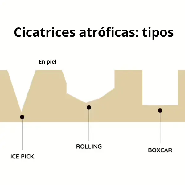 Tipos de cicatrices atróficas