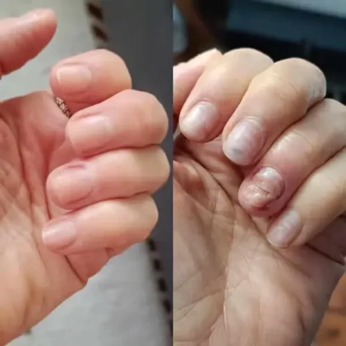 uñas antes y después de la suplementación con colágeno